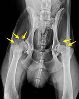 Cadera con artrosis severa. Deformidad de las cabezas femorales , normalmente esféricas, y múltiples osteofitos ( fragmentos óseos ) dañando el fémur y acetábulo ( flechas)