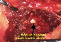 HERNIAS DISCALES Y LESIONES DE COLUMNA HERNIAS DISCALES Y LESIONES DE COLUMNA