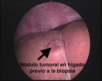 CIRUGIA ABDOMINAL Y LAPAROSCOPIA